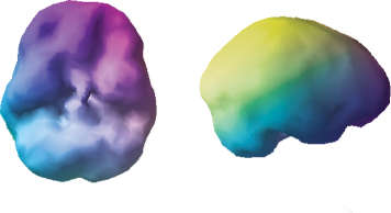 A colour 3D SPECT brain scan after treatment, shown from two angles