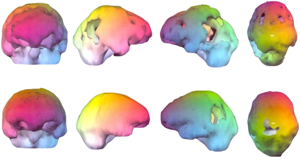 Before and after colour 3D SPECT brain scans