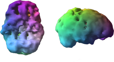 A colour 3D SPECT brain scan before treatment, shown from two angles
